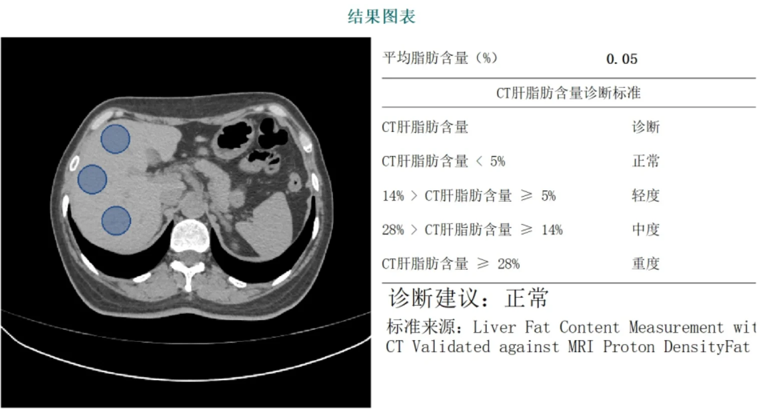 Bone's QCT Liver Analysis