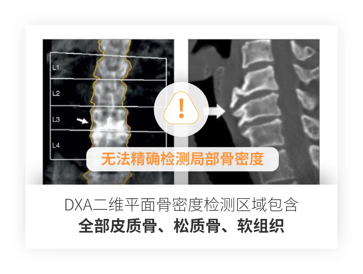 DXA vs QCT comparison