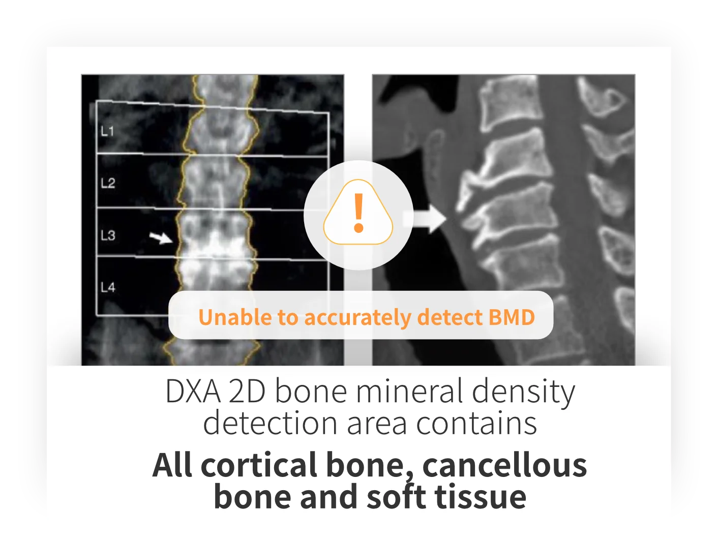 DXA vs QCT comparison