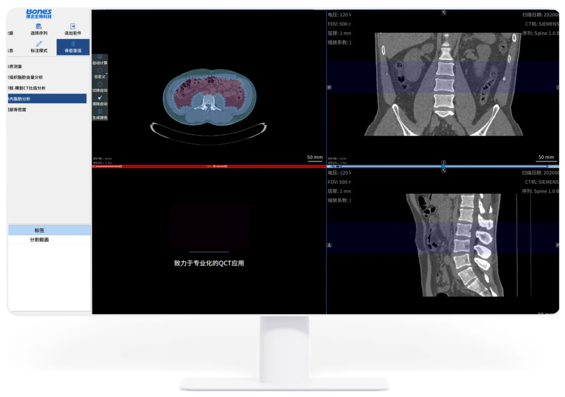 Bone's QCT Fat Analysis