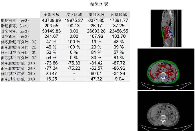 Bone's QCT Fat Analysis